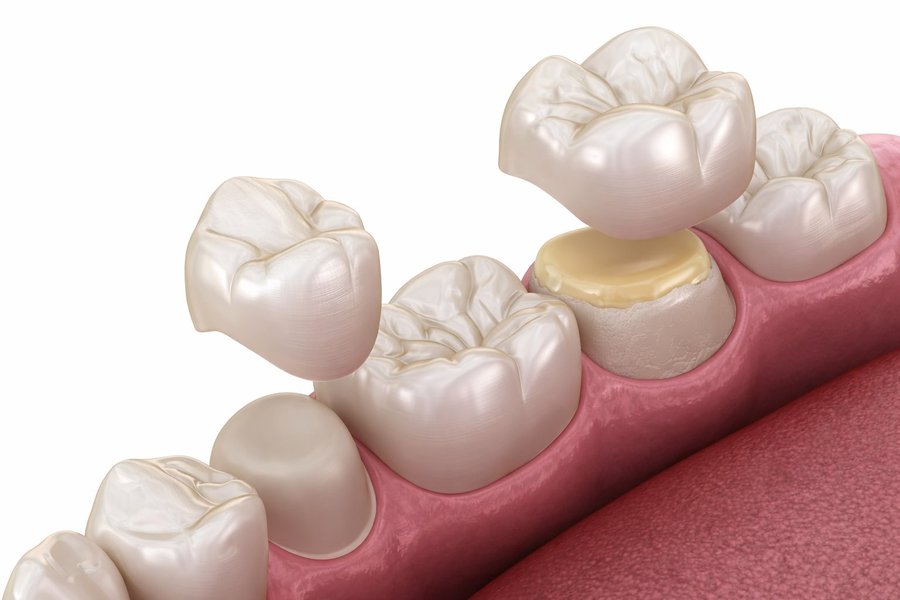 Dental bridge restoration illustration — POSH Smiles Ashburn VA