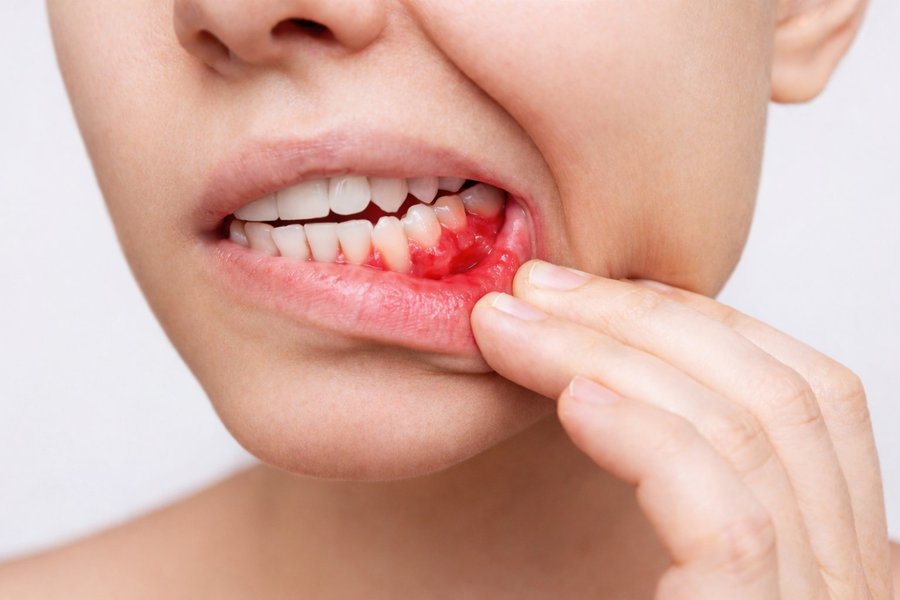 Periodontal therapy for healthy gums