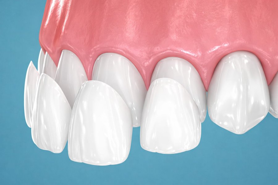 Porcelain veneers being placed on teeth illustration