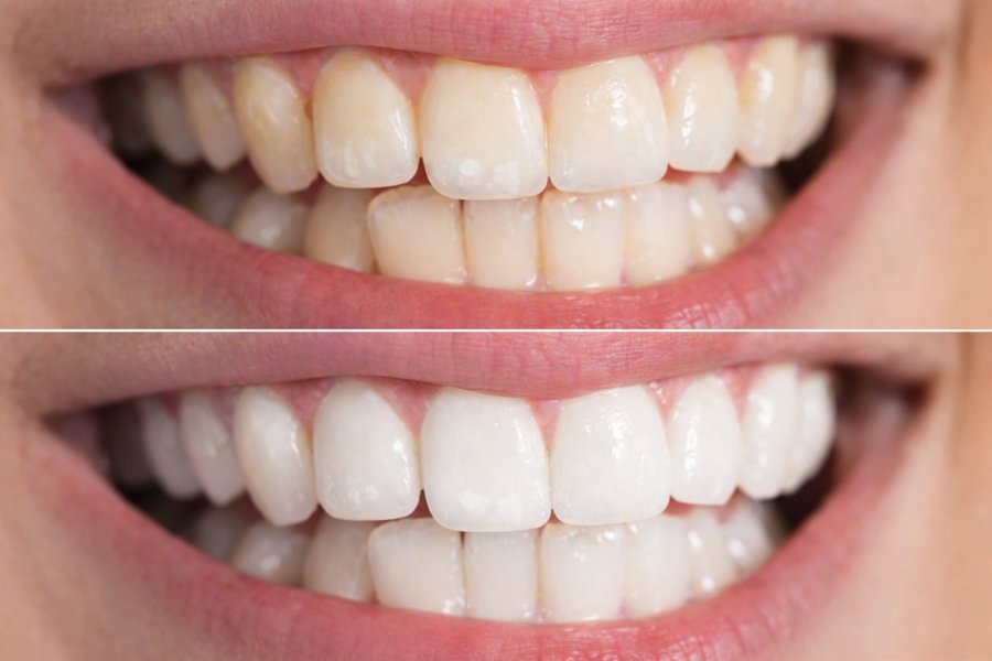 Professional teeth whitening at our Ashburn, VA dental office